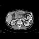 Metastatic disease of the liver, stomach carcinoma: CT - Computed tomography